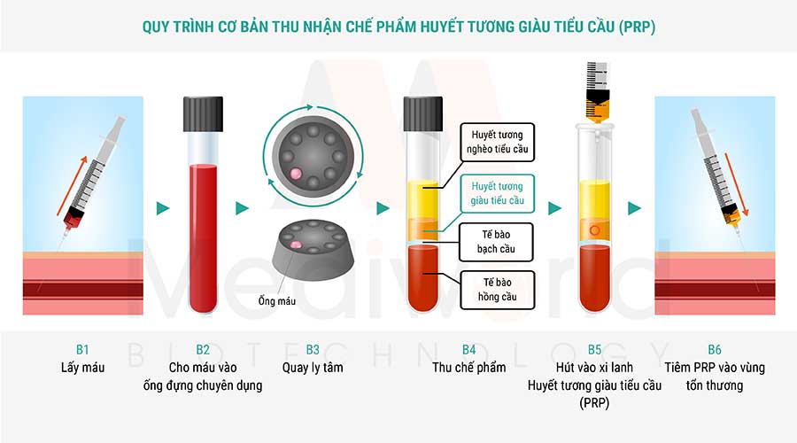 Quy trình cơ bản thu nhận chế phẩm huyết tương giàu tiểu cầu (PRP)