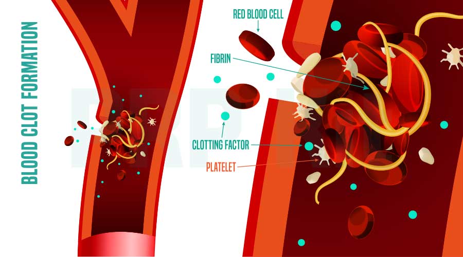 Chức năng chính của tiểu cầu là cầm máu, tạo cục máu, cục máu đông,... (*Ảnh minh họa cơ chế đông máu vết thương)