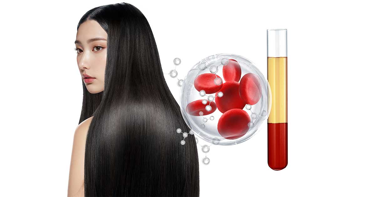PRP tóc - Giải pháp cải thiện tình trạng rụng tóc, hói đầu