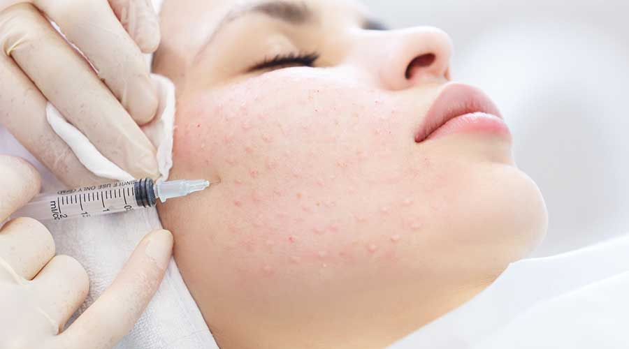 Mesotherapy là kỹ thuật tiêm vi điểm đưa các dưỡng chất trực tiếp vào lớp trung bì của da