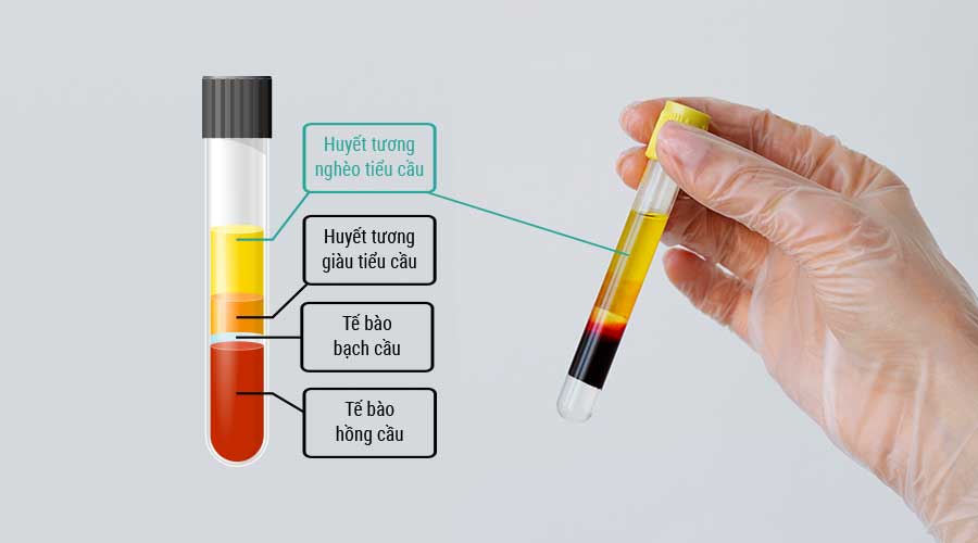 PPP - Huyết tương nghèo tiểu cầu là phần huyết tương còn lại sau khi máu được ly tâm và đã lọc phần lớn tiểu cầu