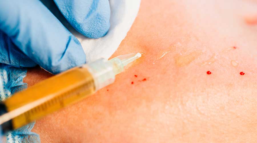 PRP Meso là sự kết hợp giữa hai phương pháp Mesotherapy và PRP trong cùng một lần tiêm