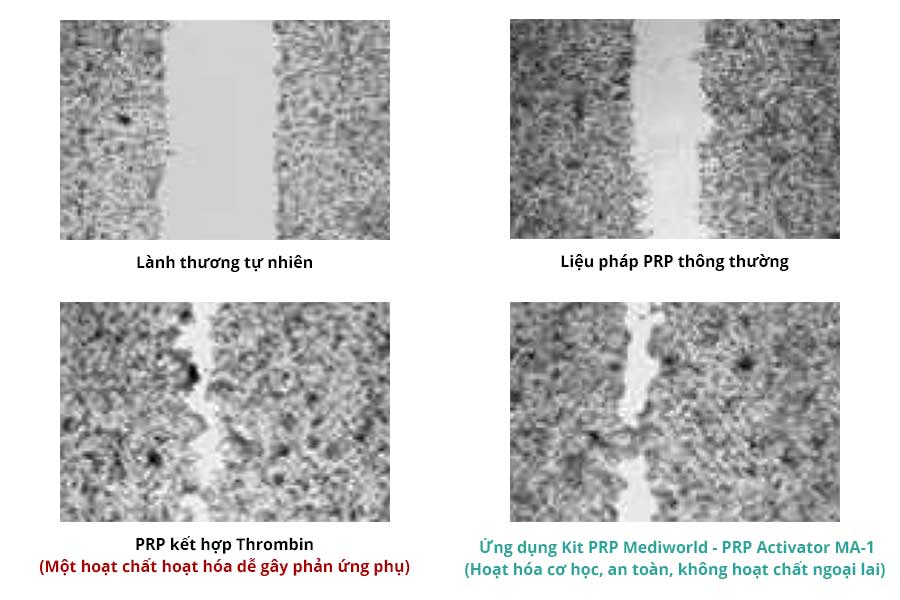 Minh chứng lâm sàng khả năng làm lành vết thương của Kit PRP Mediworld sử dụng trong Y khoa