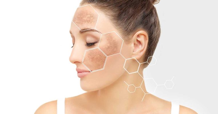 PRP trị nám - Phương pháp hỗ trợ điều hòa sắc tố da tự thân