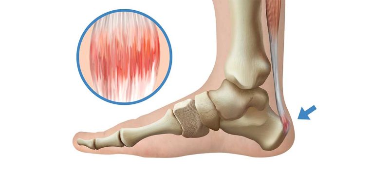 Ứng dụng PRP điều trị viêm gân hiệu quả