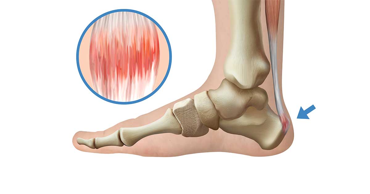 Ứng dụng PRP điều trị viêm gân hiệu quả