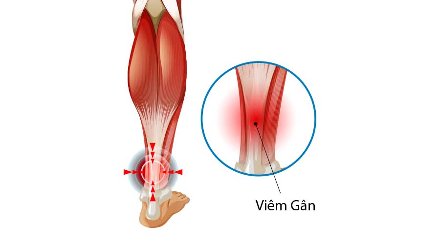 Viêm gân là tình trạng viêm hoặc thoái hóa của gân, đây là cấu trúc mô sợi có nhiệm vụ nối cơ với xương